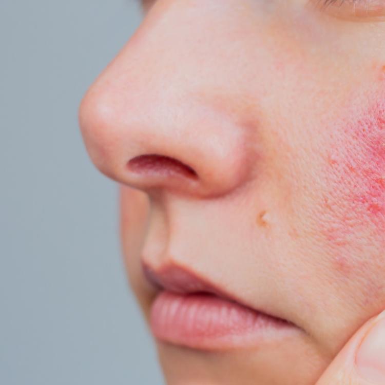A woman displaying signs of rosacea on her face